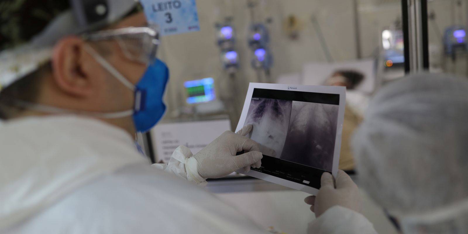 Broncopneumonia: entenda quadro que causou internação de Bolsonaro